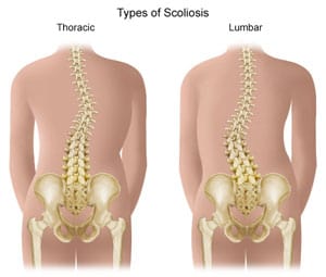 scoliosis