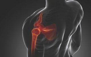 Bursitis in shoulder?How Physio can help! 3 shoulder-pain