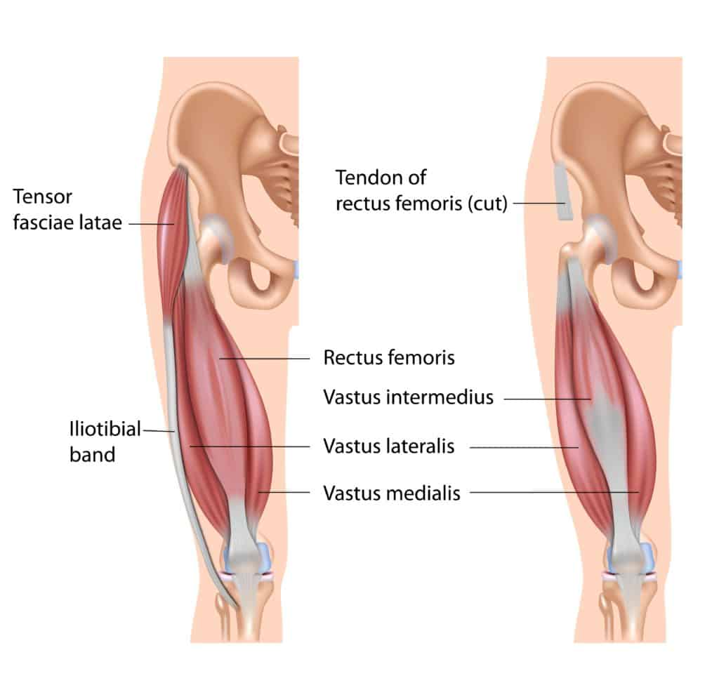 Iliotibial Band ITB, PFP, Iliotibial band