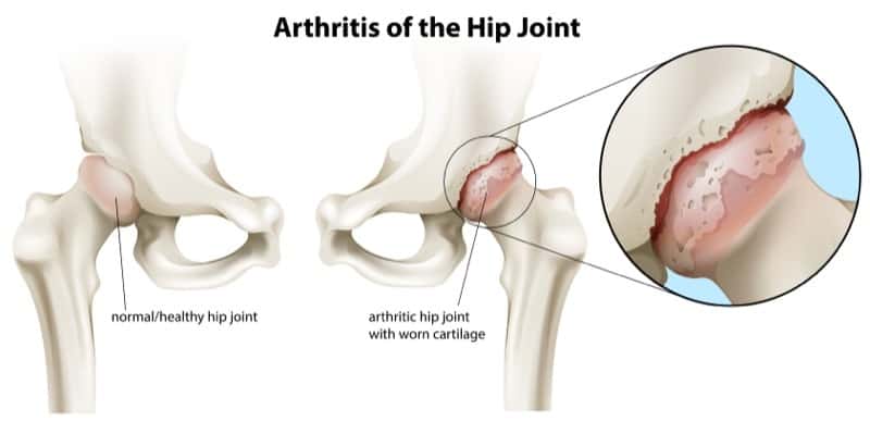 Hip Arthritis