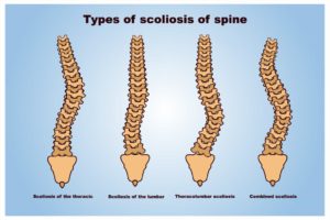 scoliosis