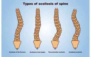 scoliosis