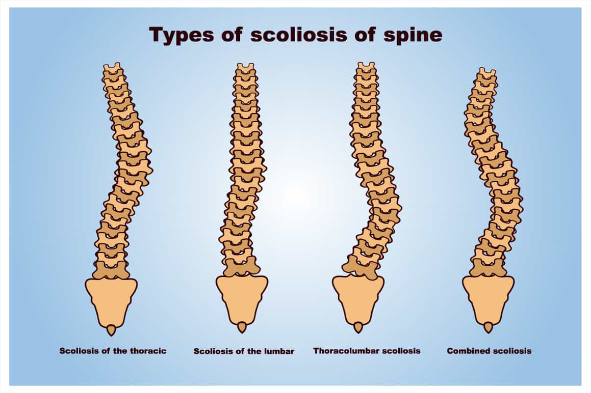 scoliosis treatment