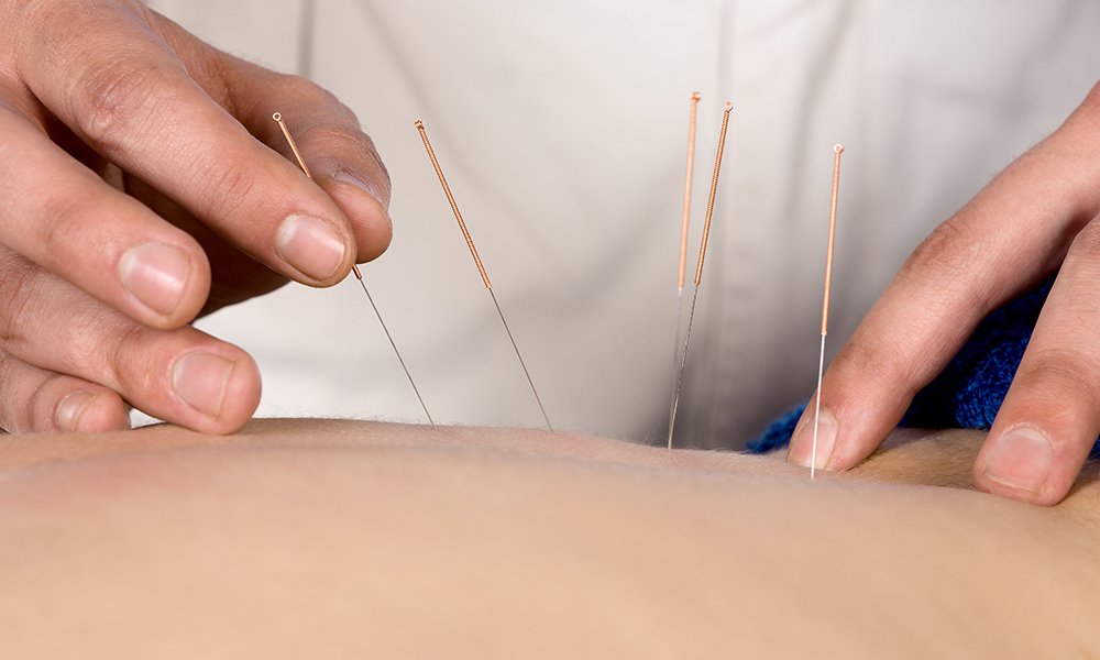 dry needling, acupuncture, acupressure