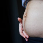 diastasis signs and symptoms